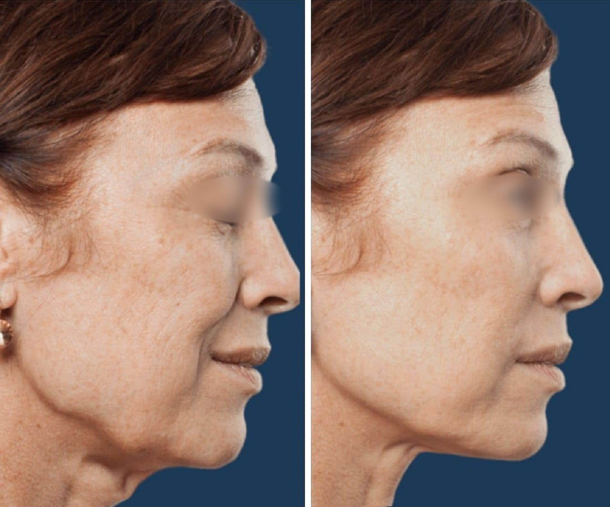 Lifting Facial y Cuello caso 10 — antes y después